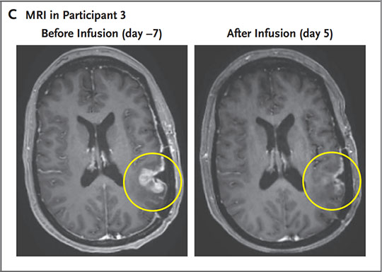  MRI in Participant 3, INCIPIENT trial