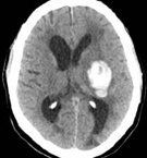 Neurologic emergencies
